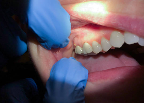 Best Emergency Treatment for Toothache in Barnesville, OH